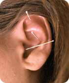 Ear acupuncture